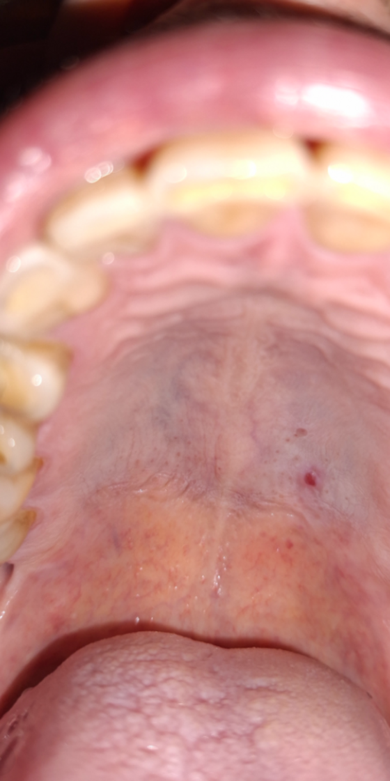 China People's Liberation Army PLA MSS nano-biochem BRAIN weapon taken after a mouth wash with Therabreath containing EDTA chelator. Notice the layers on this image are reduced, as the parasite layers over time like an onion.
